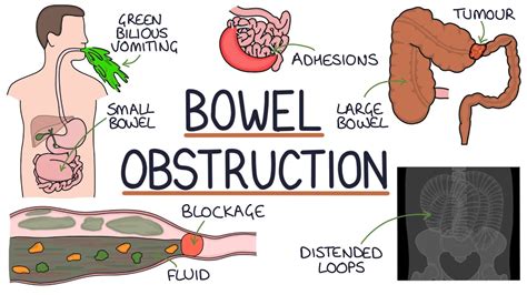 Can Bowel Problems Affect Your Back