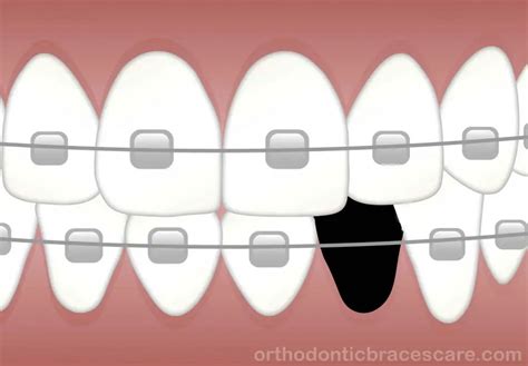 can braces fix a gap from a missing tooth