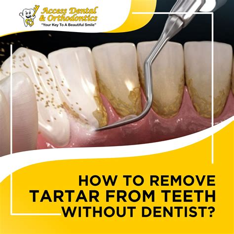 Can Brushing Remove Tartar