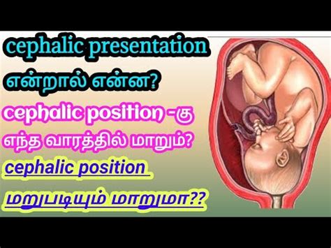 can cephalic presentation change