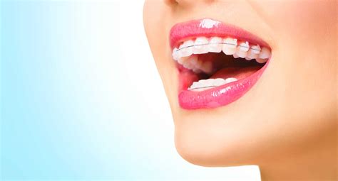 can ceramic braces damage your teeth
