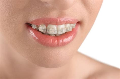 www.elyricsy.biz:can ceramic braces damage your teeth