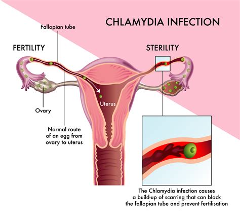 Can Chlamydia Cause Dryness During Intercourse
