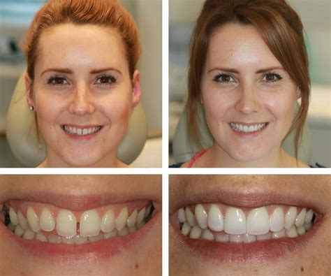 Can Composite Bonding Fix Gaps