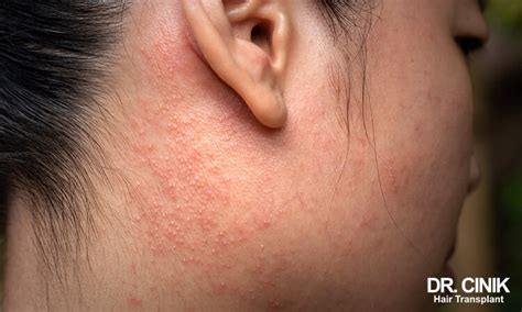 can contact dermatitis cause scabs