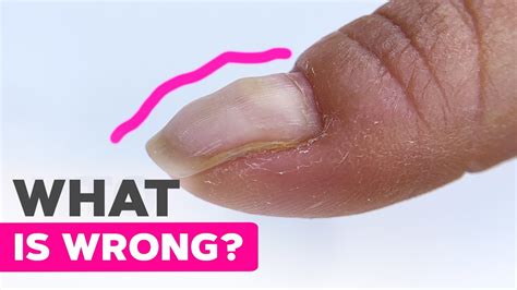 Can Deformed Fingernails Be Fixed