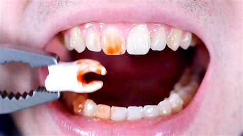 How to pull a broken tooth First Molar extraction قلع جراحي YouTube