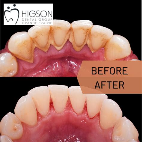 Can Dentist Remove Tartar? Explained by a Certified Dentist