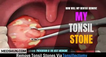 How To Remove Tonsil Stones You Can't See HOWOTREMVO