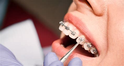 Orthodontist tightening braces Stock Image F024/3980 Science