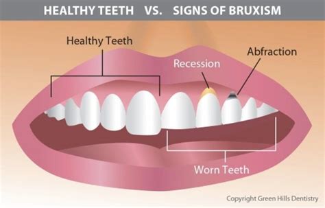 Teeth Grinding (Bruxism) Eastern Dental