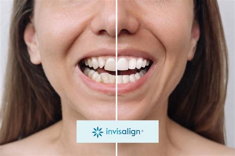 Invisalign & Invisalign Teen Dental solutions for the whole family