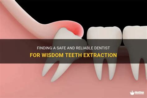 Why Get Impacted Wisdom Teeth Removed If You Feel Fine? Find Out!