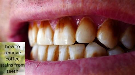 How To Remove Coffee Stains From Teeth Coffee stain removal, Teeth