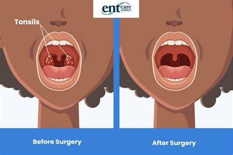 Does Removing the Tonsils Lead to More Future Diseases? YouTube