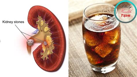 Can Drinking Soda Cause Kidney Problems