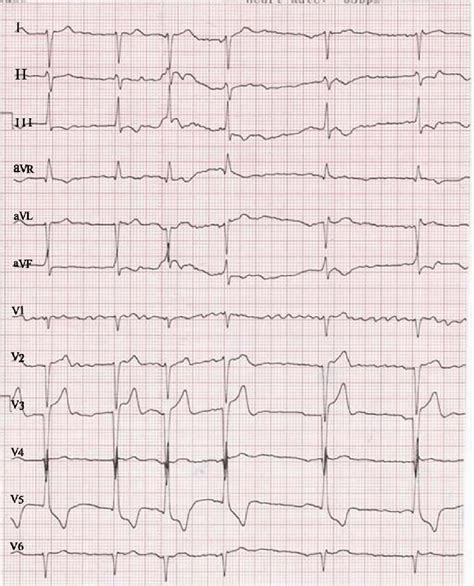Can Ecg Detect Leaky Valve
