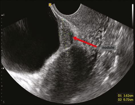can endometriosis be diagnosed by ultrasound