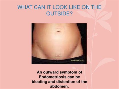 can endometriosis cause swelling abdomen