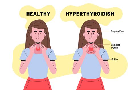can exercise affect thyroid