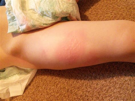 Can Fabric Softener Sheets Cause Itching