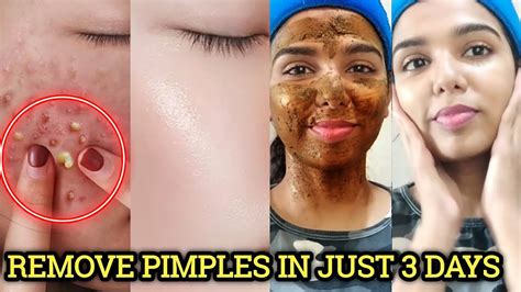 Can Face Scrub Remove Pimples