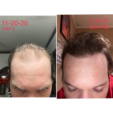 can finasteride and minoxidil regrow hairline