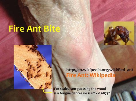 can fire ant bites get infected