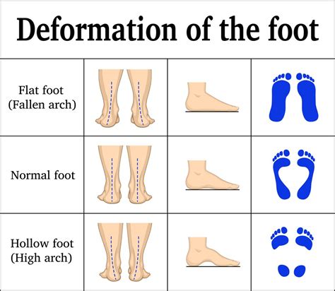 can flat feet be corrected