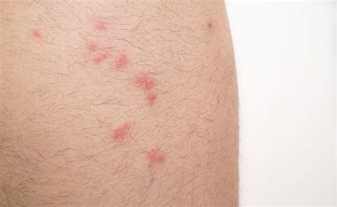 Can Flea Bites Spread From Scratching