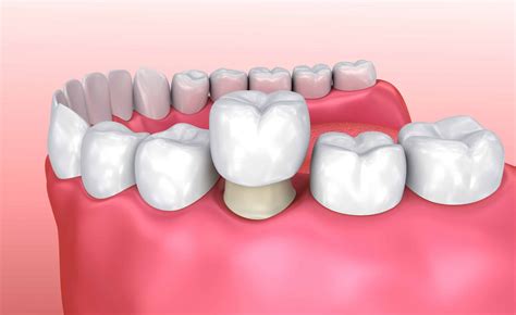 Dental Crowns Dentist Crowns White Hills Dental Crown Treatment