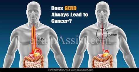 can gerd cause cancer