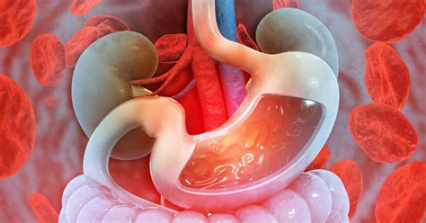 Can Gerd Cause Gi Bleed