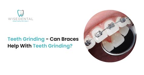 Can Grinding Teeth Break Braces