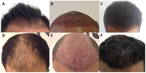 This Can Hair Transplant Be Done To Increase Density For Long Hair