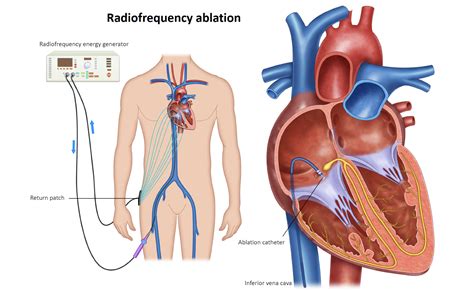 Can Heart Ablation Go Wrong
