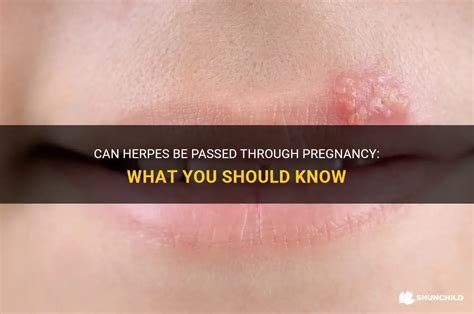 can herpes be passed to baby