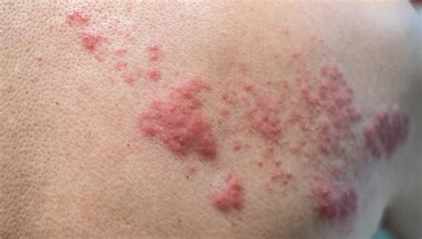 can i catch shingles from someone else