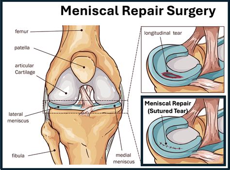 Can I Delay Meniscus Surgery