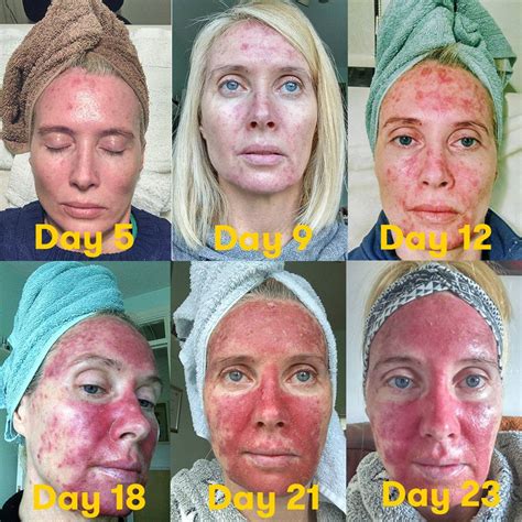 Can I Get A Facial While On Chemo