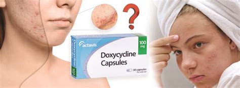 can i use doxycycline for pimples