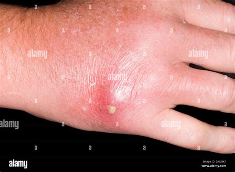 Can Insect Bite Cause Abscess