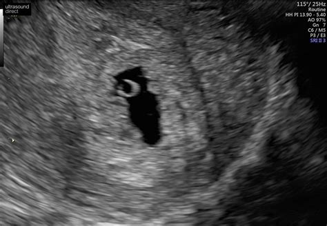 can irregular gestational sac become regular