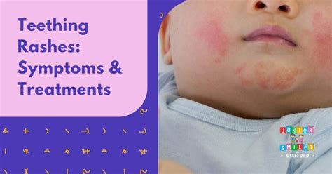 can kids get hives from teething