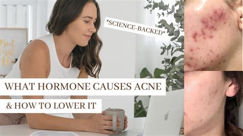Can Low Estrogen Cause Acne? Exploring the Connection Between Hormones and Skin Health
