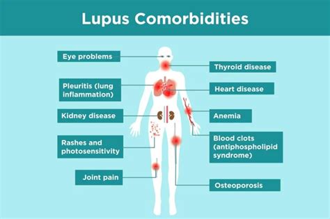 can lupus affect thyroid function