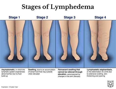 Can Lymphedema Come And Go