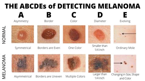 can melanoma suddenly appear