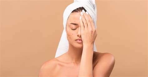 Can Microfiber Sheets Cause Acne