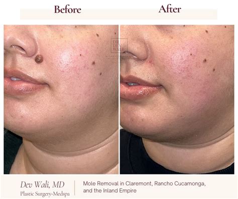 Can Moles Be Removed? Understanding the Options for Safe and Effective Mole Removal